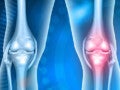 Osteoartrite uma doença das articulações: ilustração de articulações do joelho com característica de osteoartrite
