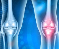Osteoartrite uma doença das articulações: ilustração de articulações do joelho com característica de osteoartrite